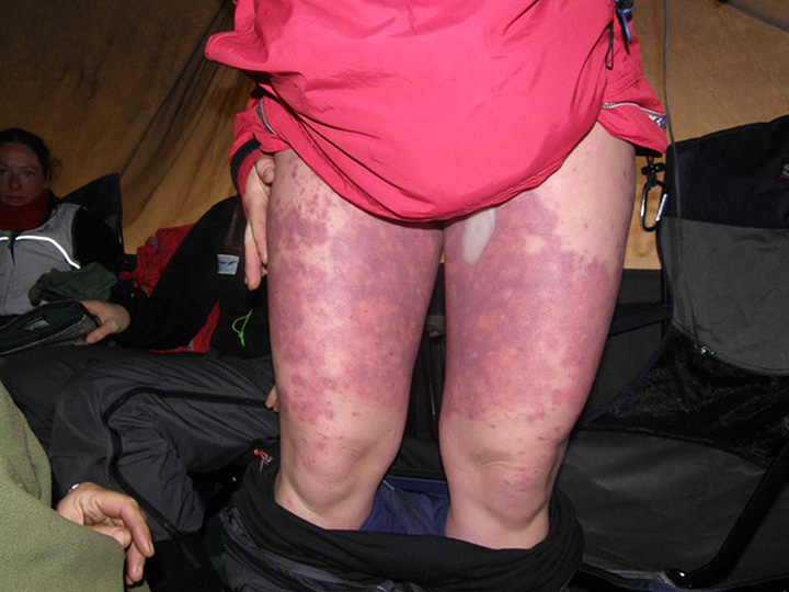 A relatively mild case of polar femoral disease. Photo courtesy of Richard Weber