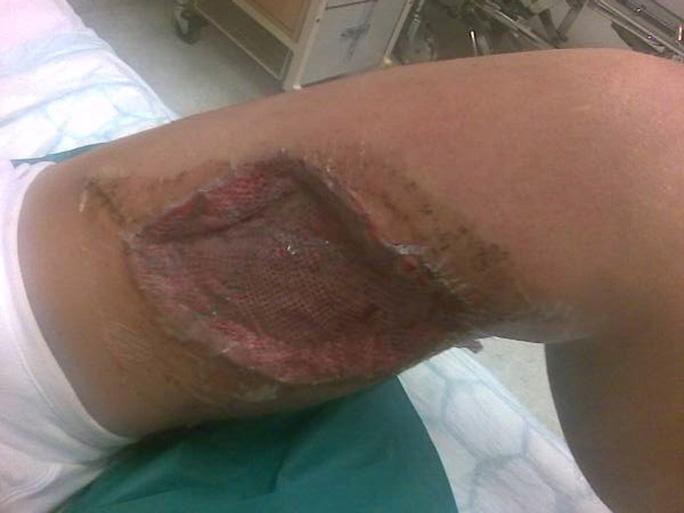 A severe case of polar hip. Photo courtesy of Lars Ebbesen